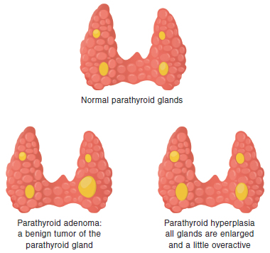 Multiple Endocrine Neoplasia (MEN) Type 2 | American Thyroid Association